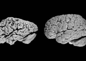 First drug of the brain in Alzheimer’s heralds a momentous