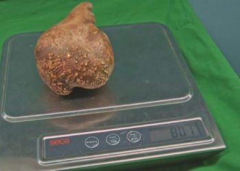 Sri Lankan doctors remove ‘world’s largest kidney stone’