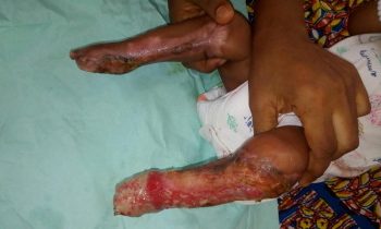 IHRA exposes unregistered hospital in newborn limbs burning case