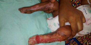 IHRA exposes unregistered hospital in newborn limbs burning case