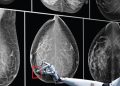AI could halve time reading breast cancer scans