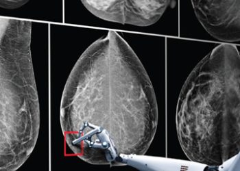AI could halve time reading breast cancer scans