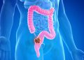 Scientist finds alarming discovery, hidden colon cancer risks uncovered