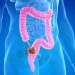 Scientist finds alarming discovery, hidden colon cancer risks uncovered