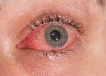 Pink eye outbreak: Viral conjunctivitis cases spike to near 100,000 in Punjab