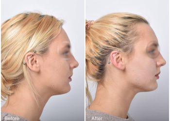 Experts share treatments of ‘turkey neck’ to help reverse it