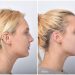 Experts share treatments of ‘turkey neck’ to help reverse it