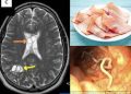 Doctors find worm eggs in Florida man’s brain