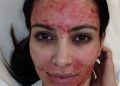 3 women diagnosed with HIV after receiving ‘vampire facial’