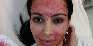 3 women diagnosed with HIV after receiving ‘vampire facial’