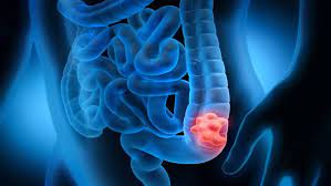 The miracle new drug offers treatment of colorectal cancer without surgery