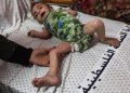 Dangerous skin diseases spreading among children in Gaza