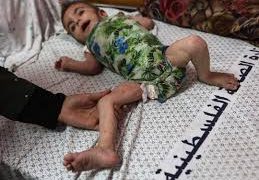 Dangerous skin diseases spreading among children in Gaza