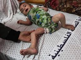 Dangerous skin diseases spreading among children in Gaza