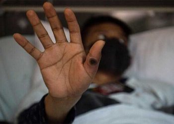 KP reports three confirm cases of monkeypox virus