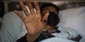 KP reports three confirm cases of monkeypox virus