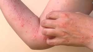 Ministry of Health issues advisory on chikungunya