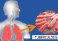 WHO declares Pakistan among five high-burden TB countries