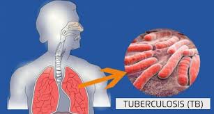 WHO declares Pakistan among five high-burden TB countries