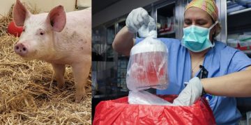 Chinese surgeons successfully transplant pig liver into human