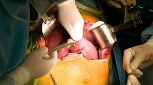 Doctors perform first liver transplant surgery at Dow Karachi