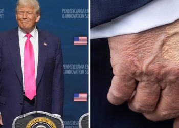 Trump diagnosed with ‘chronic venous insufficiency’