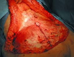 Hyderabad Civil Hospital performs first successful free tummy tuck surgery